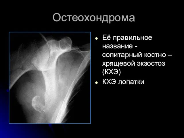 Остеохондрома Её правильное название - солитарный костно – хрящевой экзостоз (КХЭ) КХЭ лопатки