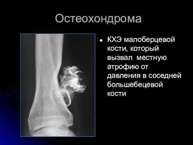 Остеохондрома КХЭ малоберцевой кости, который вызвал местную атрофию от давления в соседней большебецевой кости