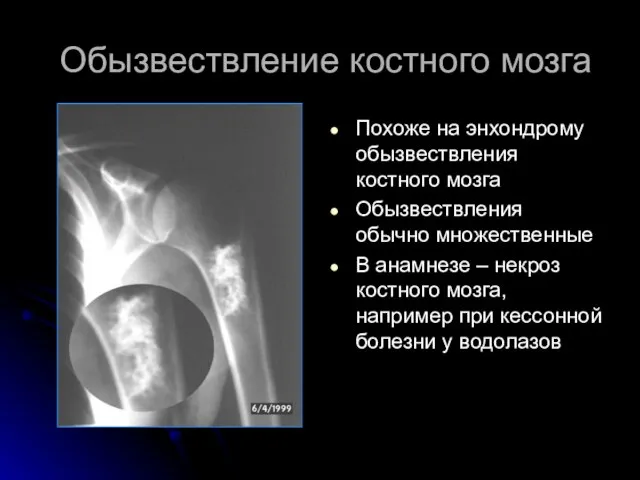 Обызвествление костного мозга Похоже на энхондрому обызвествления костного мозга Обызвествления обычно