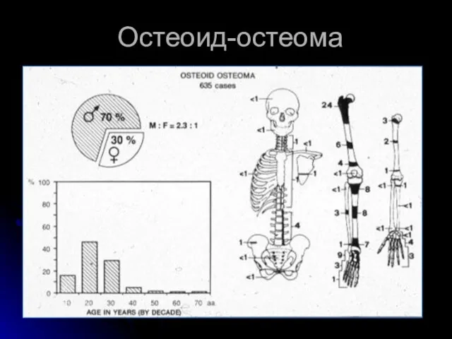 Остеоид-остеома