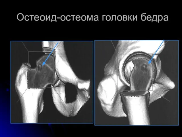 Остеоид-остеома головки бедра