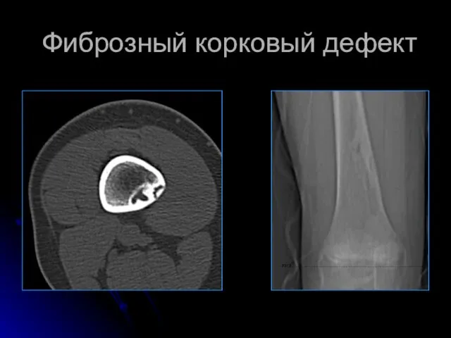 Фиброзный корковый дефект