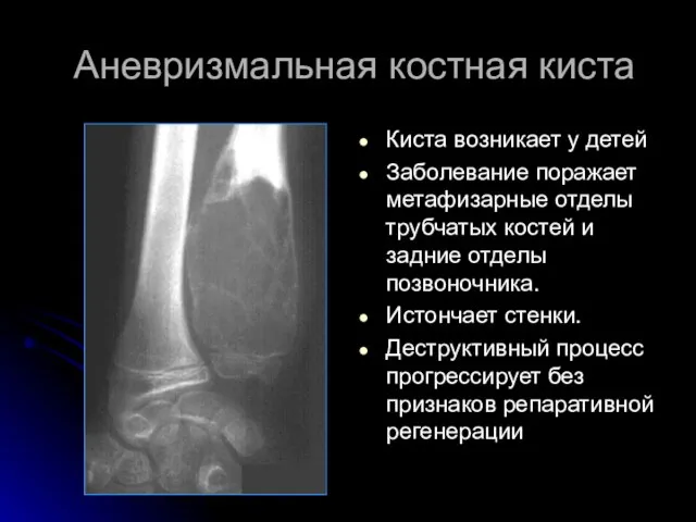 Аневризмальная костная киста Киста возникает у детей Заболевание поражает метафизарные отделы