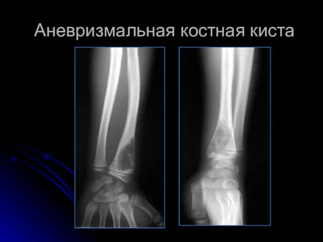 Аневризмальная костная киста