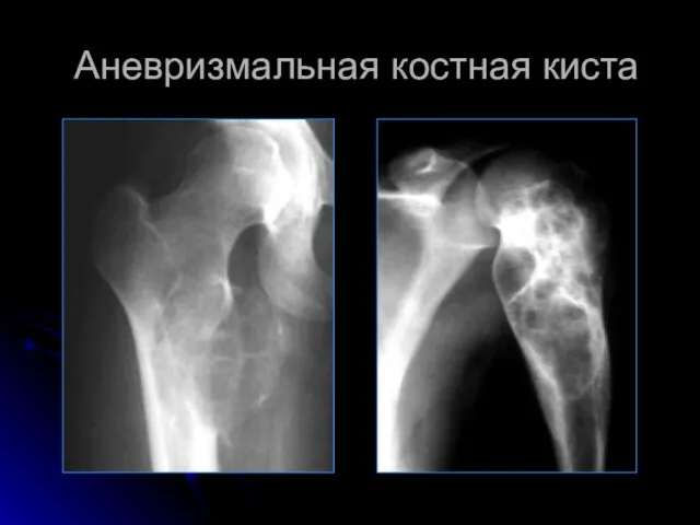 Аневризмальная костная киста