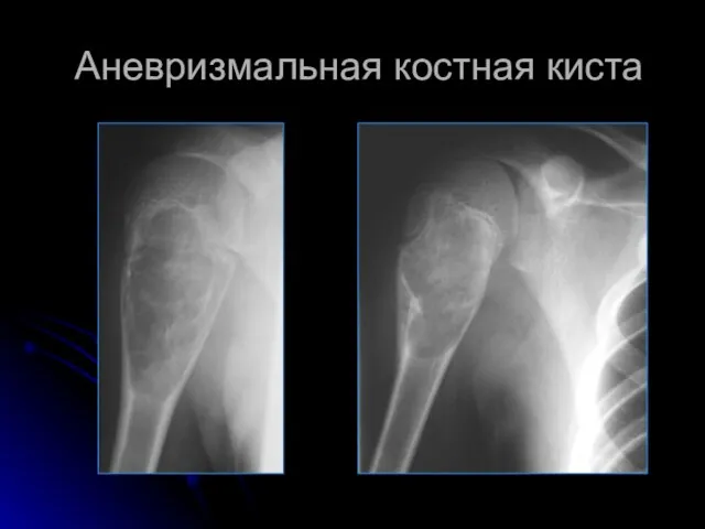 Аневризмальная костная киста