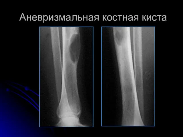 Аневризмальная костная киста