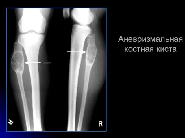 Аневризмальная костная киста