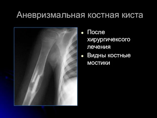 Аневризмальная костная киста После хирургичексого лечения Видны костные мостики