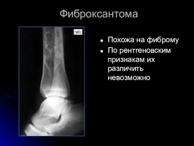 Фиброксантома Похожа на фиброму По рентгеновским признакам их различить невозможно