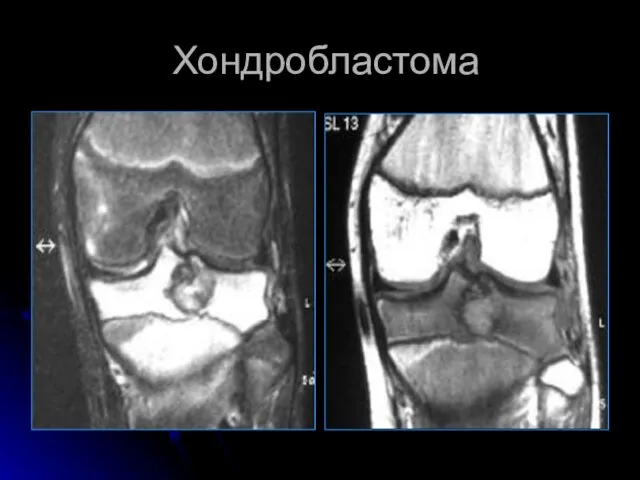 Хондробластома