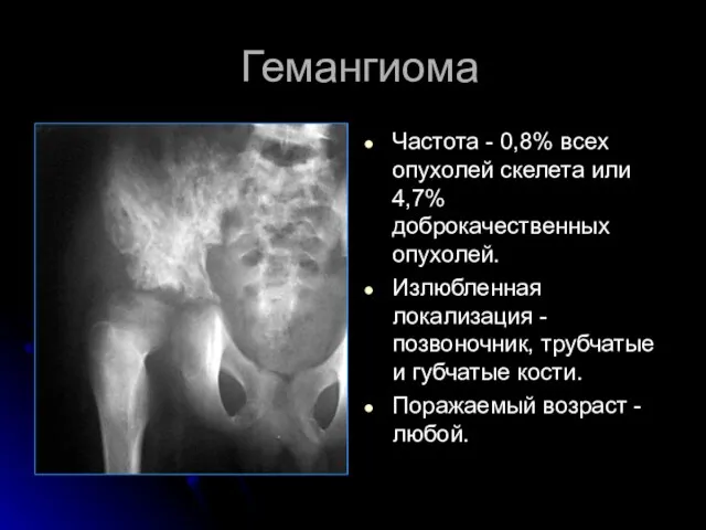 Гемангиома Частота - 0,8% всех опухолей скелета или 4,7% доброкачественных опухолей.