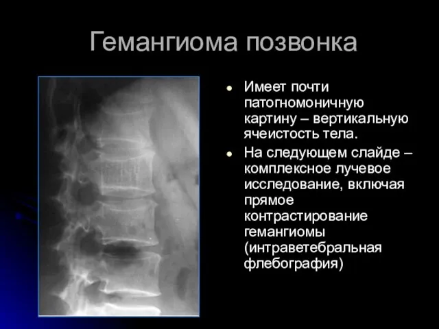 Гемангиома позвонка Имеет почти патогномоничную картину – вертикальную ячеистость тела. На