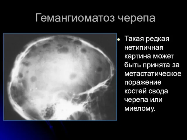 Гемангиоматоз черепа Такая редкая нетипичная картина может быть принята за метастатическое