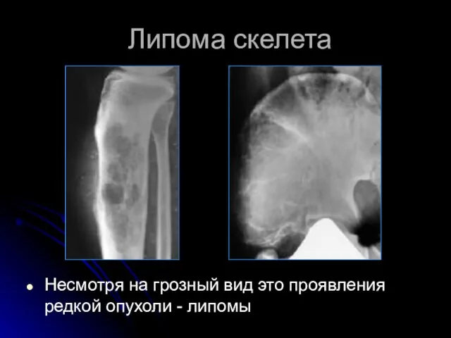 Липома скелета Несмотря на грозный вид это проявления редкой опухоли - липомы