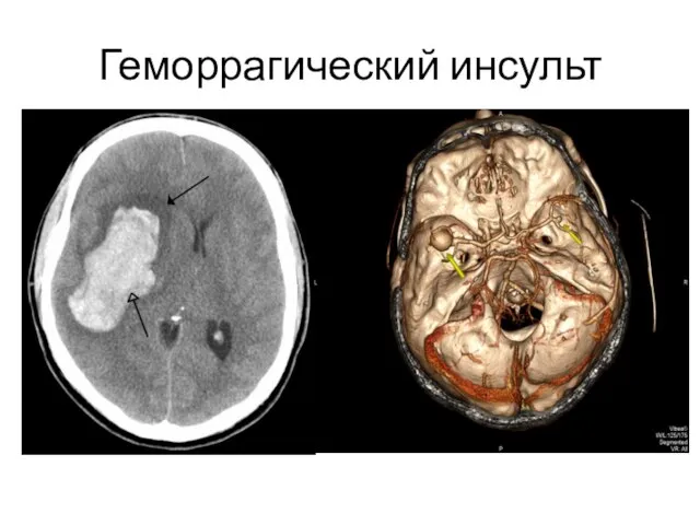 Геморрагический инсульт