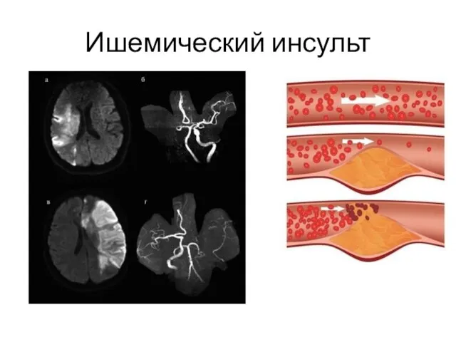 Ишемический инсульт