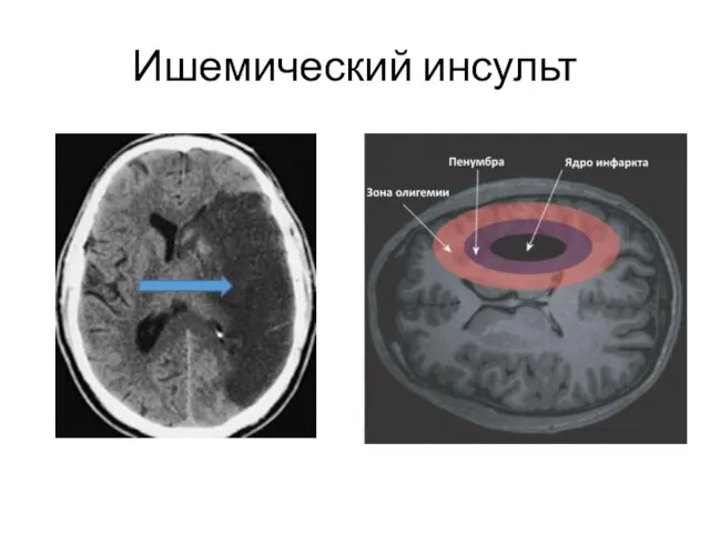 Ишемический инсульт