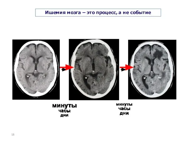 минуты часы дни минуты часы дни Ишемия мозга – это процесс, а не событие