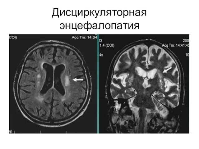 Дисциркуляторная энцефалопатия