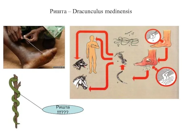 Ришта – Dracunculus medinensis Ришта !!!???