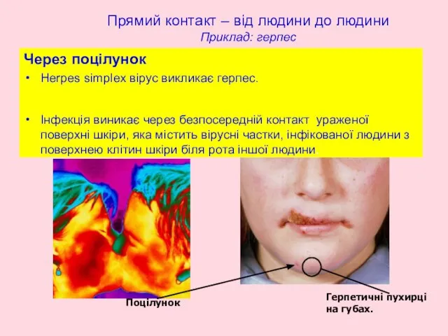 Прямий контакт – від людини до людини Приклад: герпес Через поцілунок