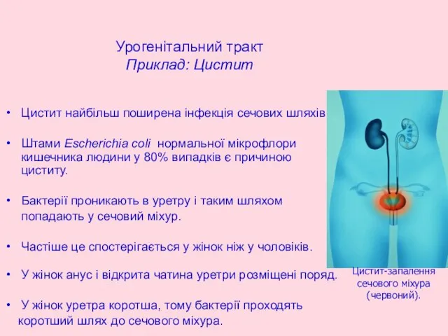 Цистит найбільш поширена інфекція сечових шляхів. Штами Escherichia coli нормальної мікрофлори