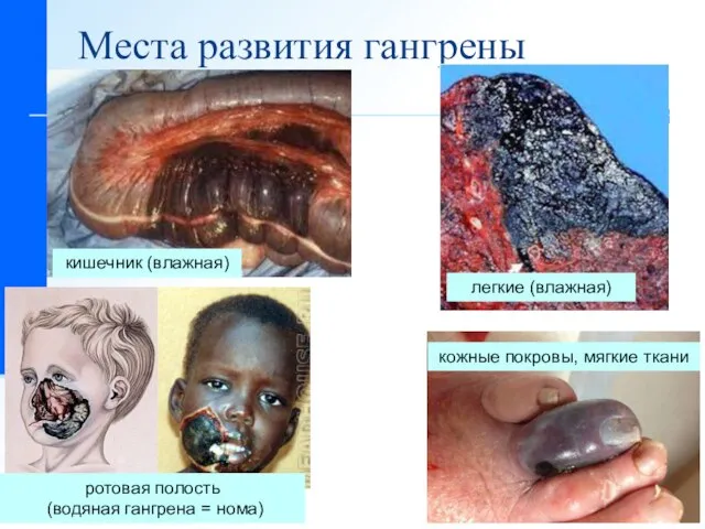 Места развития гангрены легкие (влажная) кишечник (влажная) ротовая полость (водяная гангрена