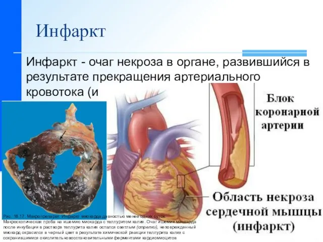 Инфаркт Инфаркт - очаг некроза в органе, развившийся в результате прекращения