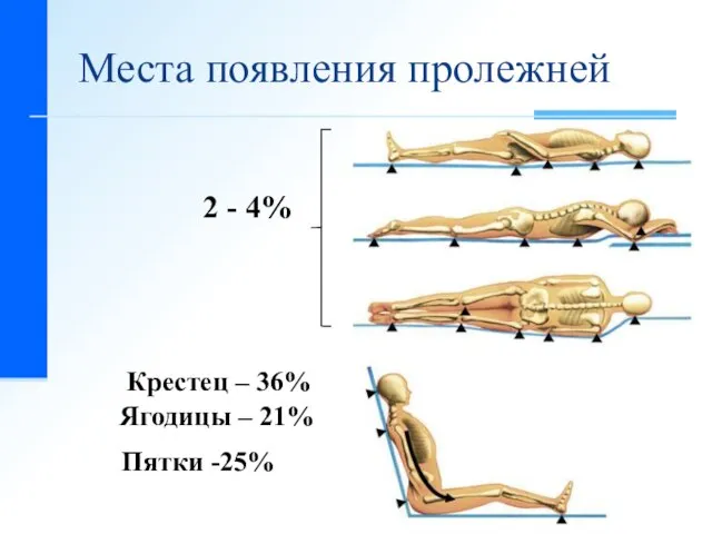 2 - 4% Крестец – 36% Ягодицы – 21% Пятки -25% Места появления пролежней