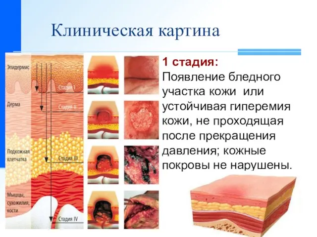 Клиническая картина 1 стадия: Появление бледного участка кожи или устойчивая гиперемия