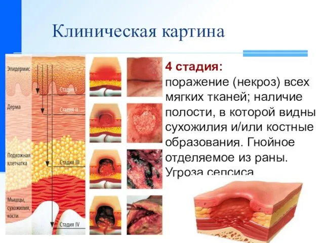 Клиническая картина 4 стадия: поражение (некроз) всех мягких тканей; наличие полости,