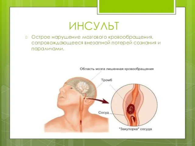 ИНСУЛЬТ Острое нарушение мозгового кровообращения, сопровождающееся внезапной потерей сознания и параличами.