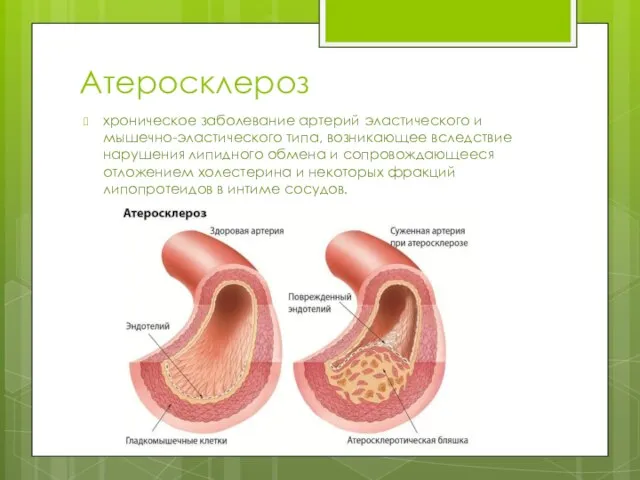 Атеросклероз хроническое заболевание артерий эластического и мышечно-эластического типа, возникающее вследствие нарушения