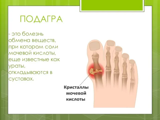 ПОДАГРА - это болезнь обмена веществ, при котором соли мочевой кислоты,