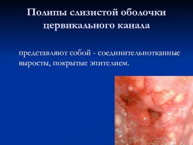 Полипы слизистой оболочки цервикального канала представляют собой - соединительнотканные выросты, покрытые эпителием.