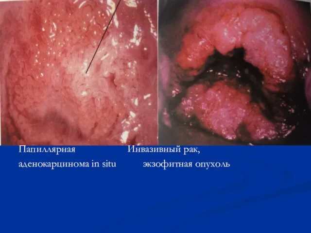 Папиллярная Инвазивный рак, аденокарцинома in situ экзофитная опухоль