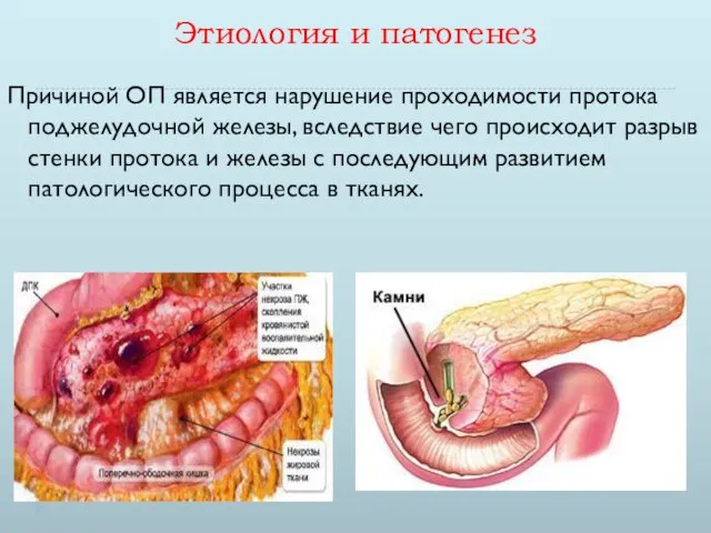 Этиология и патогенез Причиной ОП является нарушение проходимости протока поджелудочной железы,