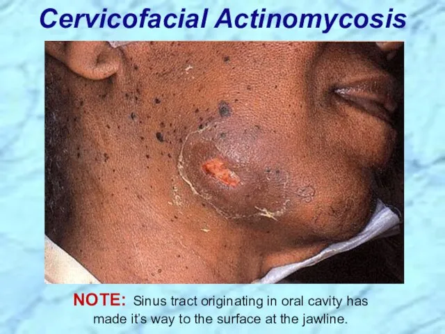 Cervicofacial Actinomycosis NOTE: Sinus tract originating in oral cavity has made