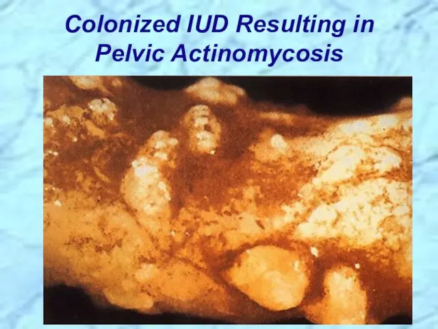 Colonized IUD Resulting in Pelvic Actinomycosis