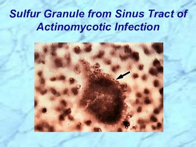 Sulfur Granule from Sinus Tract of Actinomycotic Infection