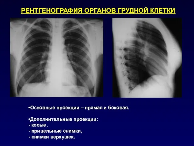 РЕНТГЕНОГРАФИЯ ОРГАНОВ ГРУДНОЙ КЛЕТКИ Основные проекции – прямая и боковая. Дополнительные