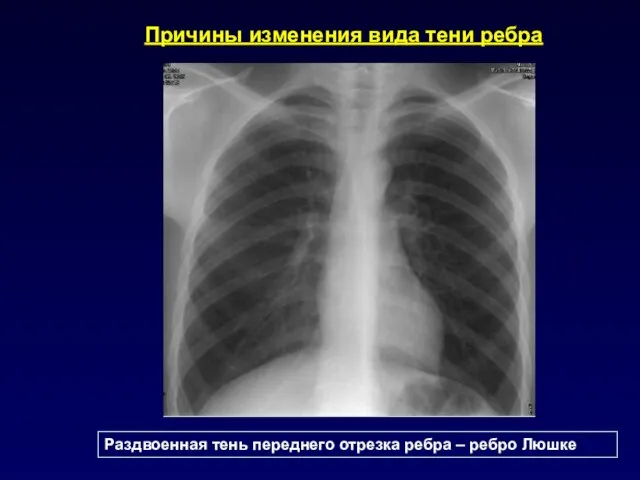 Причины изменения вида тени ребра Раздвоенная тень переднего отрезка ребра – ребро Люшке