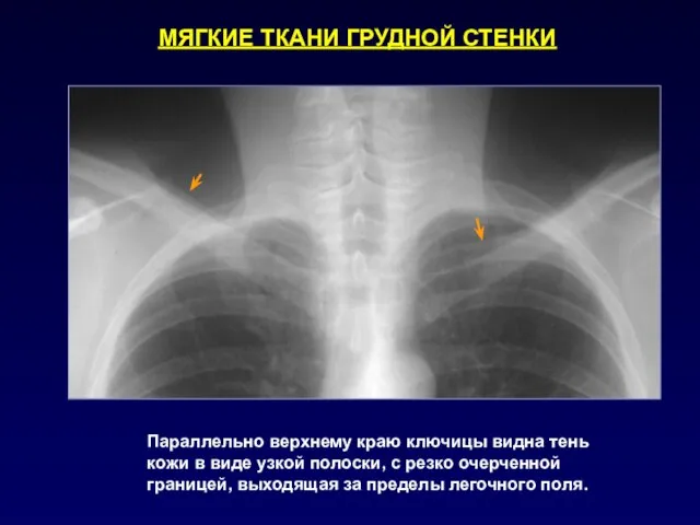 МЯГКИЕ ТКАНИ ГРУДНОЙ СТЕНКИ Параллельно верхнему краю ключицы видна тень кожи