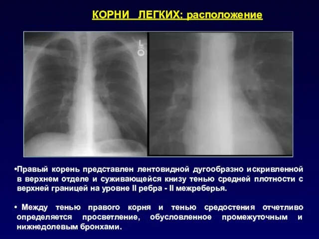 Правый корень представлен лентовидной дугообразно искривленной в верхнем отделе и суживающейся