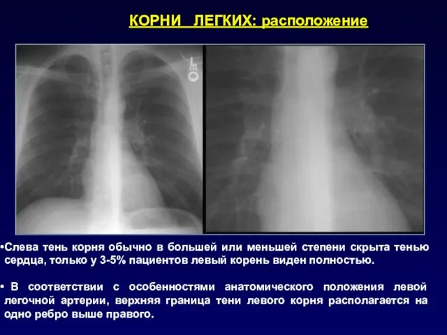 Слева тень корня обычно в большей или меньшей степени скрыта тенью