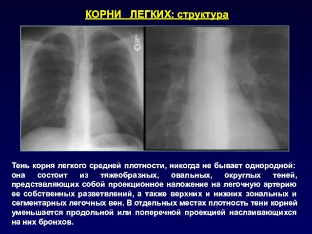 Тень корня легкого средней плотности, никогда не бывает однородной: она состоит