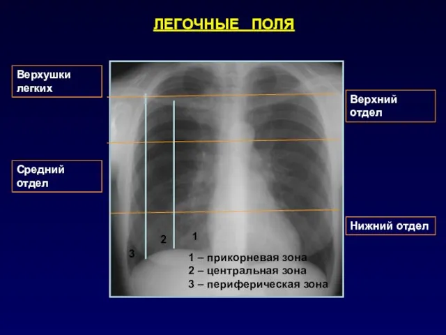 ЛЕГОЧНЫЕ ПОЛЯ Верхний отдел Средний отдел Нижний отдел Верхушки легких 1