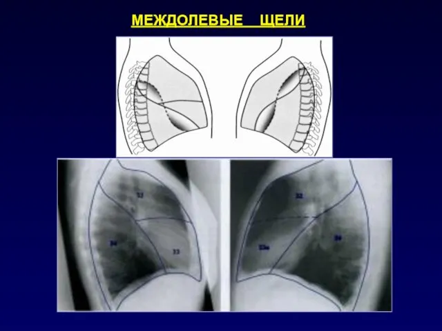 МЕЖДОЛЕВЫЕ ЩЕЛИ