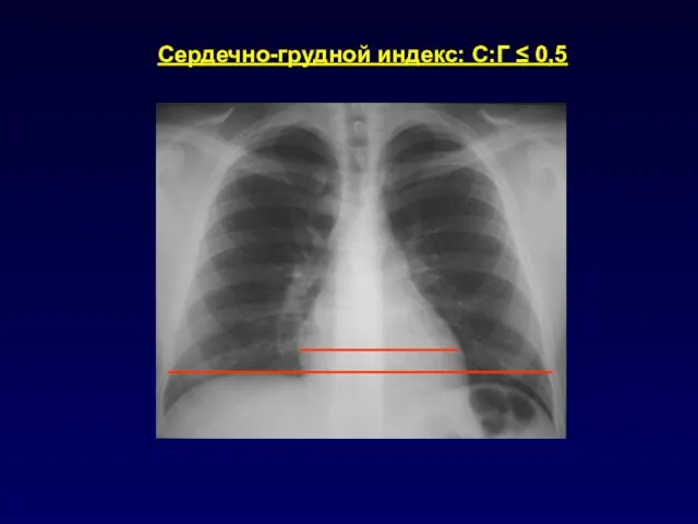 Сердечно-грудной индекс: С:Г ≤ 0,5